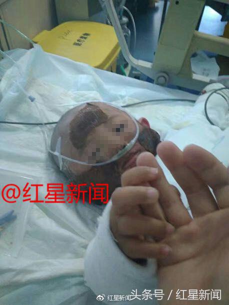 4岁女童遭开水烫伤最终结果,2岁女儿被开水烫伤完整版