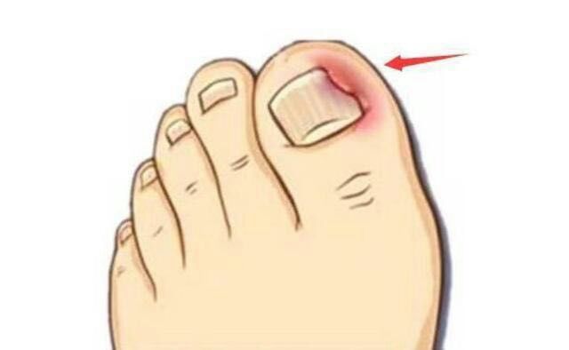 脚趾甲长到肉里很疼怎么止疼,脚趾甲长肉里一碰就痛咋办