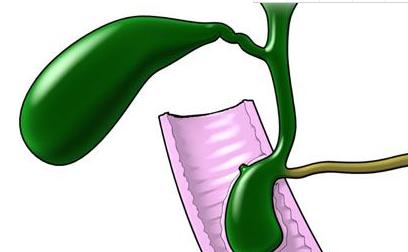 急性胆囊炎我们该如何治疗?