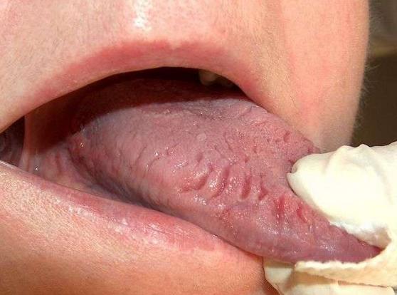 舌头有点皱证明什么,舌头边缘褶皱是什么原因