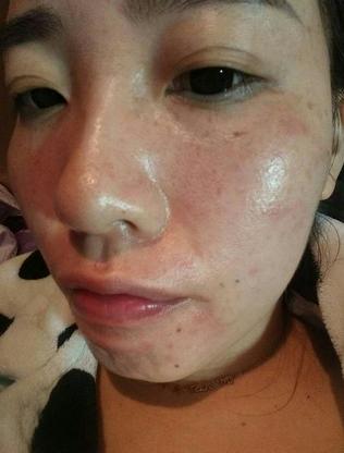 妈妈为女儿消脸上疤,妈妈为了孩子不容易