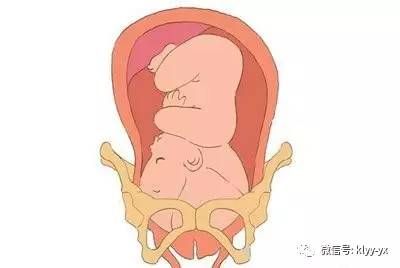 分娩时胎头径线的变化,临产胎头降低会自愈吗