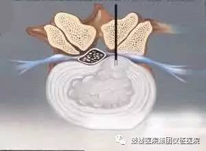 冷冻消融微创手术治肿瘤,柳叶刀肿瘤消融治疗