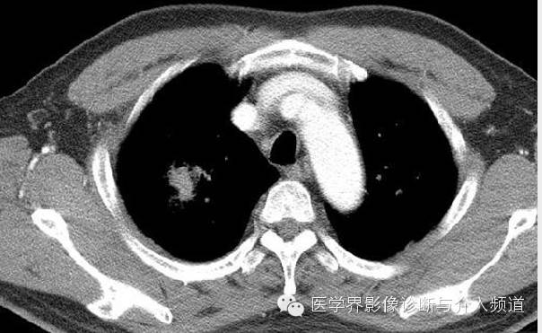 咳嗽排除了肺部的问题,咳嗽为什么比不咳好