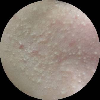 战痘合集完整版,战痘大结局完整版