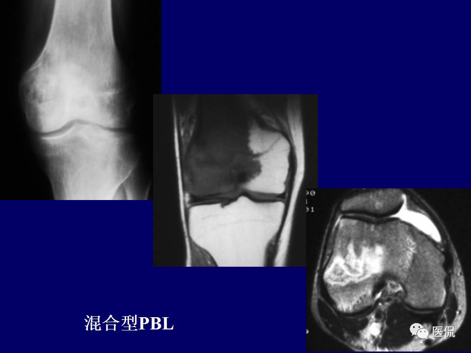 徐文坚老师精讲：原发性骨淋巴瘤影像学诊断医学影像精品PPT