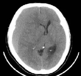 慢性硬膜下血肿手术后复查ct,硬膜下血肿ct值68hu是什么意思