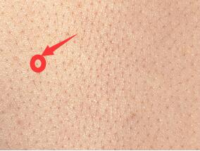 打针四种手法,什么手法打针不疼