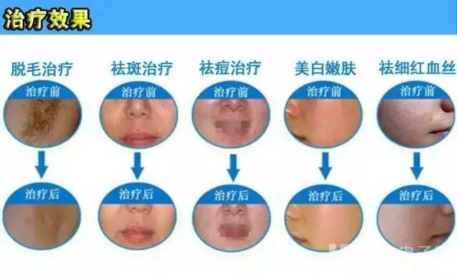 乌鲁木齐祛痘痘最好的地方,乌鲁木齐专业消除痘痘