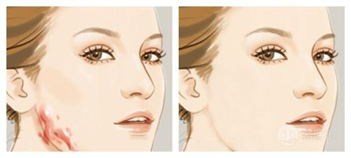 每天涂抹姜片可以去除疤痕,姜片擦疤痕真的可以祛疤吗