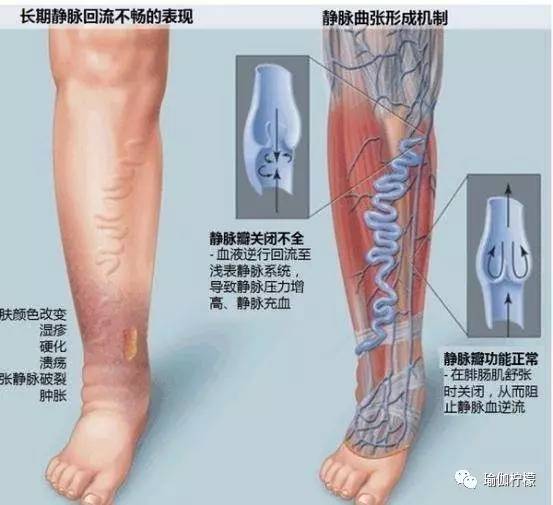 静脉曲张瑜伽怎么练,哪些瑜伽动作能缓解静脉曲张