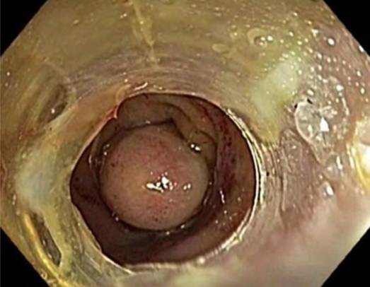 内镜下肌切开术手术步骤,肌肉活检最新技术