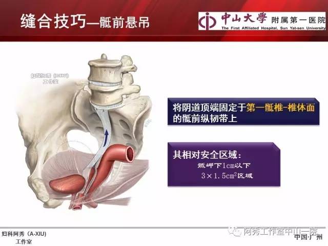 妇科腹腔镜下常用缝合技巧