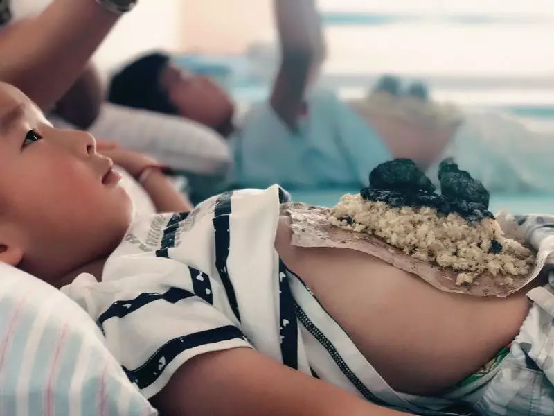 一叶知秋，雪中送炭话艾灸