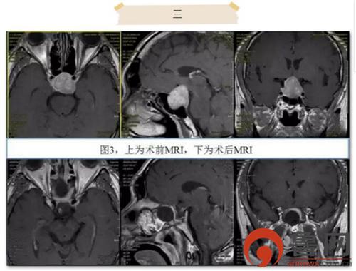 青岛齐鲁医院神经外科住院部,齐鲁医院青岛院区神经内科