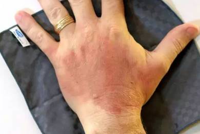 90度开水大面积烫伤急救,儿童开水烫伤急救处理