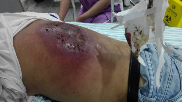 小疖子，有时可能也会要命！