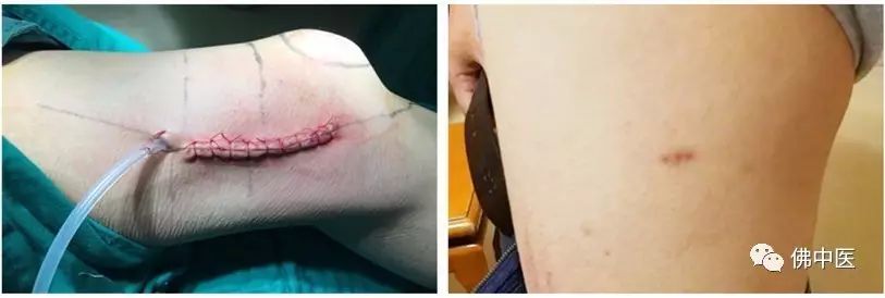 「高超」微创直达深巢，射频消融病灶，佛中医治疗骨样骨瘤有新招