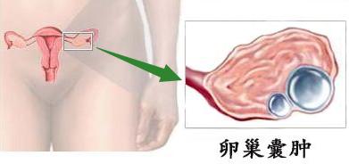 女性患上三大瘤罪魁祸首竟是内分泌失调专栏