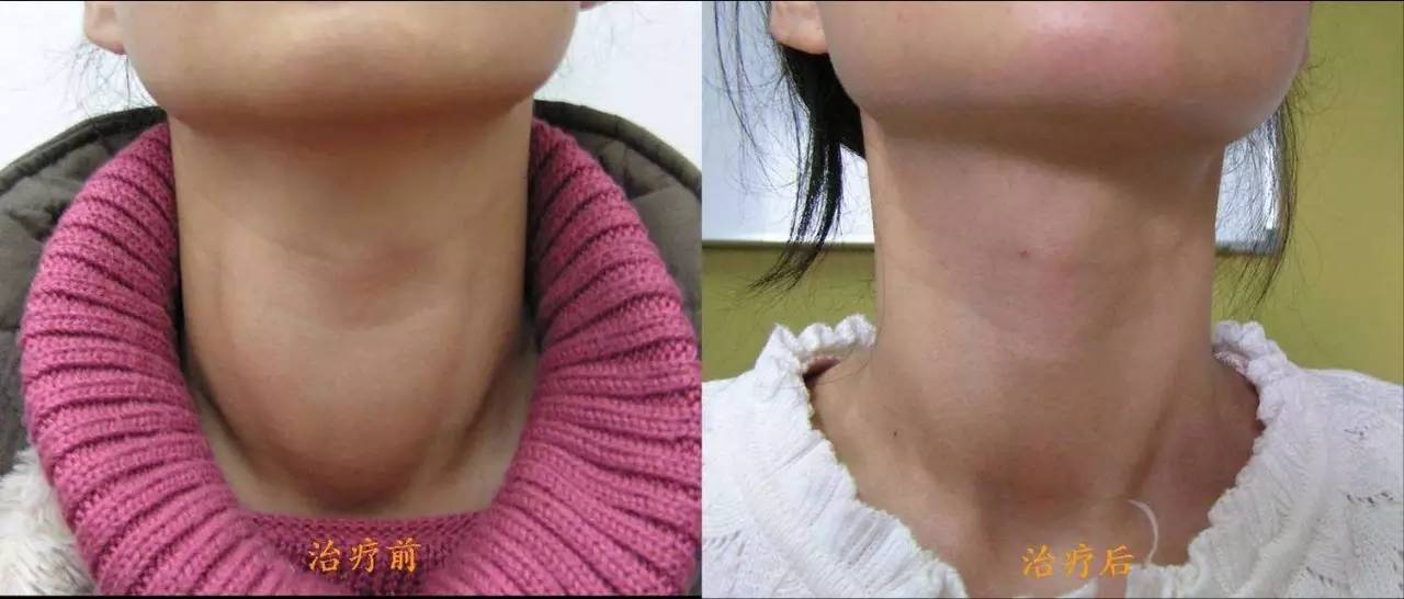 如何呵护甲状腺,保护甲状腺吃什么药