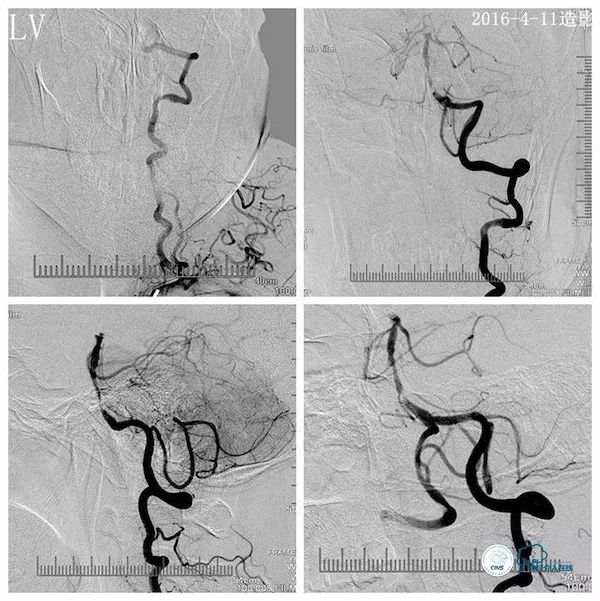 天坛医院脑血管狭窄手术做得好吗,天坛医院动脉狭窄介入手术费用