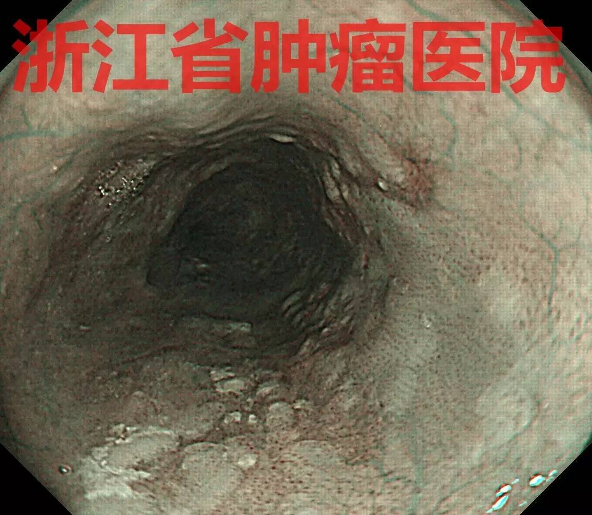 食管黏膜病变越大就一定是恶性吗,食管病变严重需要怎么治疗