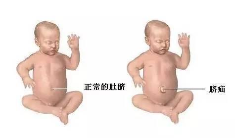 新生儿三凹是什么症状,新生儿脐疝怎么护理