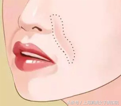 有了法令纹特显老教你1招立减10岁,法令纹消除立刻减龄5岁