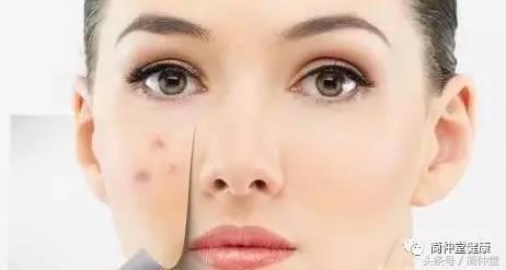 正确有效的抗痘6个绝招,三步抗痘