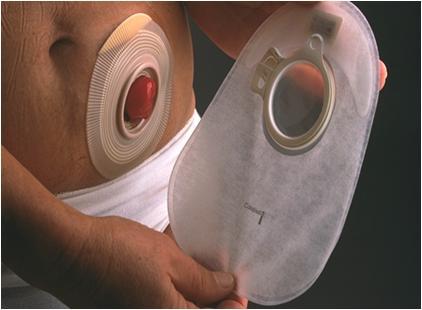 癌症造口怎么护理,肿瘤患者的护理诊断及护理措施ppt