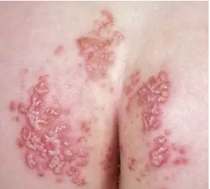 宝宝红屁股跟妈妈心情有关吗,宝宝红屁股怎么缓解疼痛