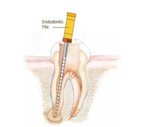 根管治疗牙痛还需要做吗,牙痛为什么要补牙