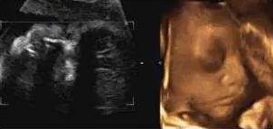 孕期做四维彩超宝宝不配合怎么办,四维产检宝宝不配合怎么办