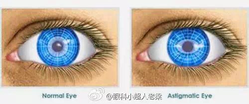 儿童近视眼家长也不用太焦虑,孩子散光几岁治疗最好