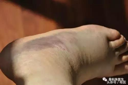 踝关节骨折没有手术怎么办,骨折保守治疗可以活动踝关节吗