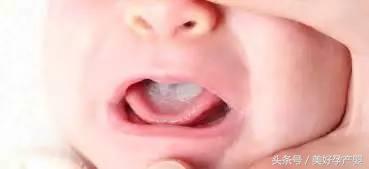 宝宝鹅口疮吃什么药不复发,宝宝怎么预防不长鹅口疮