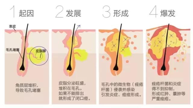 春风十里，都不如痘痘远离你！