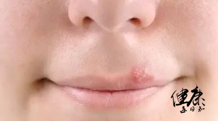 嘴巴上火起泡是病毒还是细菌,病毒性上火嘴上长泡多久能好