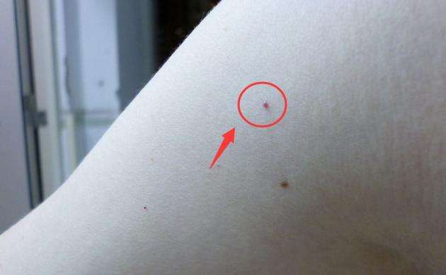 有像痣一样的小红点不痛不痒,身上长小红点像小白点