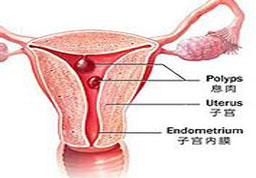 宫颈息肉可以怀孕吗,宫颈息肉怎么知道是恶性还是良性