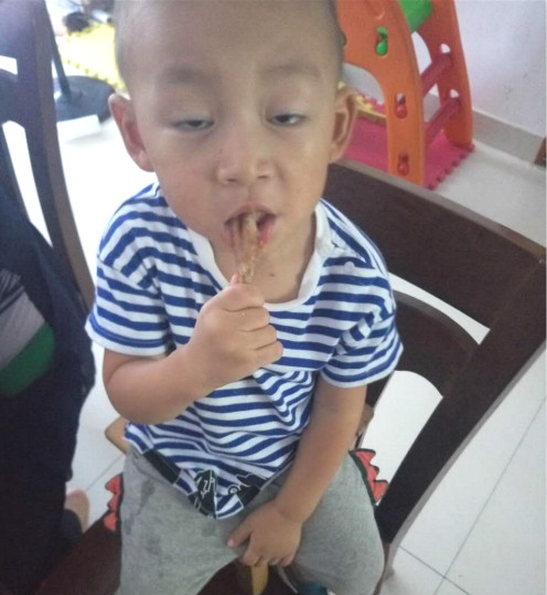 2岁宝宝老是得咽峡炎疱疹,得了疱疹性咽峡炎还会有手足口吗