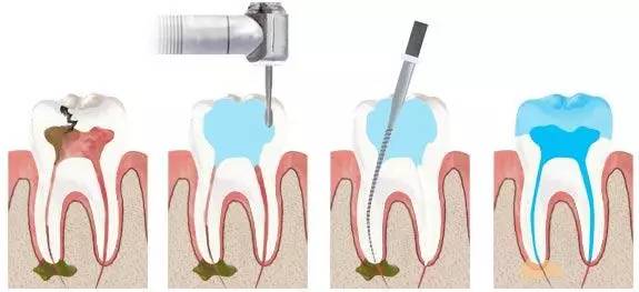 根管治疗加修复牙齿,根管治疗的牙齿都要打桩吗