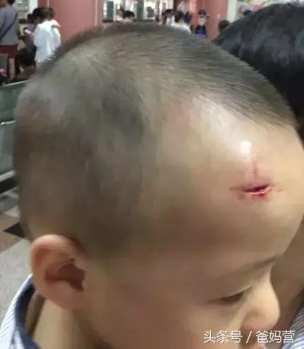 孩子摔跤到膝盖出血该怎么处理,四岁孩子摔跤缝了22针