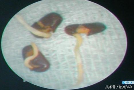 小孩把红豆塞进耳朵里面该咋办,小男孩把豆子塞耳朵里了