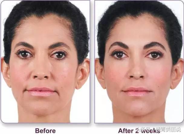 孩子刚出生就有法令纹,15岁小孩为啥有法令纹