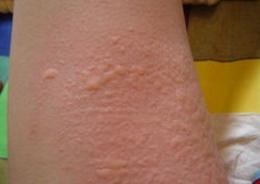 情绪不好出现皮肤病,情绪不稳定得皮肤病