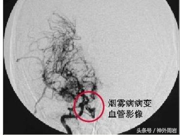 烟雾病脑内出血,烟雾病脑室出血死亡率