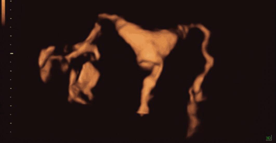 四维超声输卵管造影亲身经历,无痛四维输卵管造影