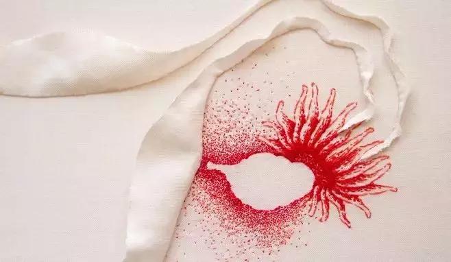 卵巢癌复发怎么治疗,卵巢癌转移脾一般剩下多长时间