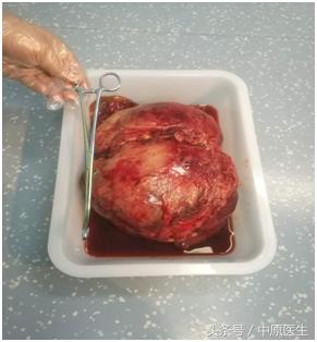 5岁女孩肚子突然变大,4岁女孩肚子肿瘤